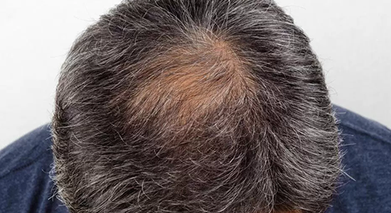 Men who go Grey/Bald Before Age 40 Risk Heart Attack 