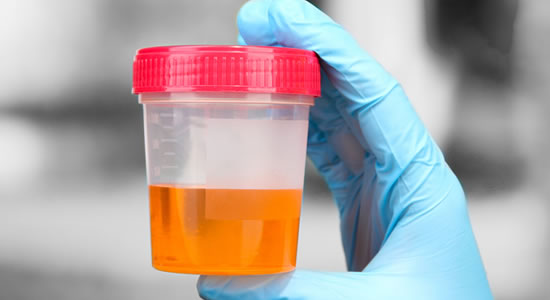 Urine Test Can Aid Detect Certain Levels Of Cancer